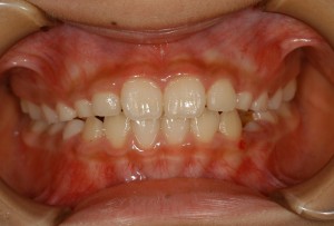 短期間で上下4前歯反対咬合・叢生治る-入江クリニック症例写真