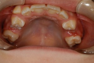 11才  2ヶ月口腔内上顎第二乳臼歯生え変わり　永久歯がうっすらと見えます。
