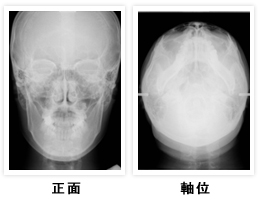 頭部X線規格撮影（正貌、軸位）の画像